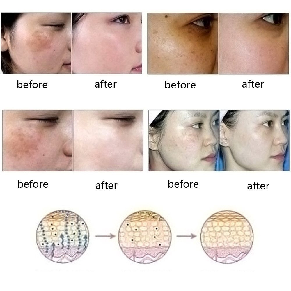 natural acne scar removal oil