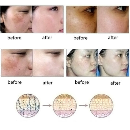 natural acne scar removal oil